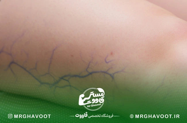 واریس کشاله ران در بارداری