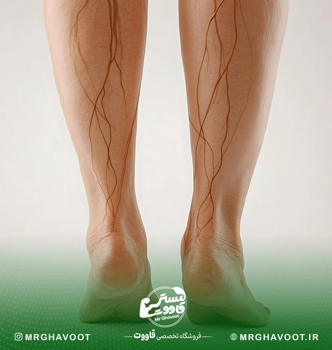 واریس پا در بارداری