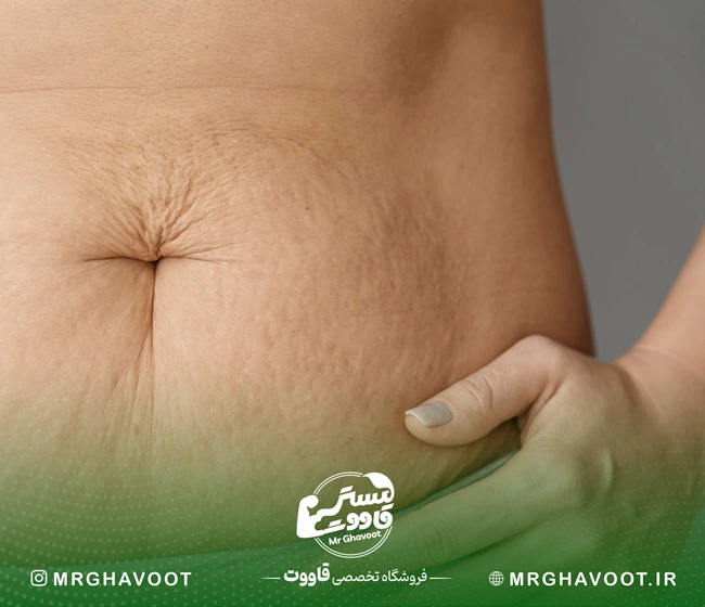 ترک شکم در بارداری