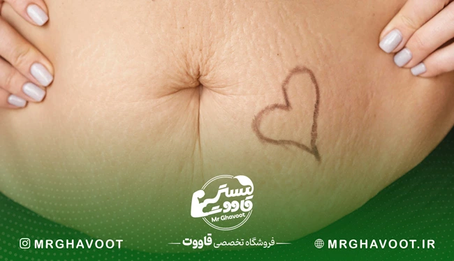 عوامل تشدیدکننده ترک‌های پوستی در بارداری